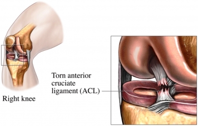 ACL tears can be helped with various types of exercises.